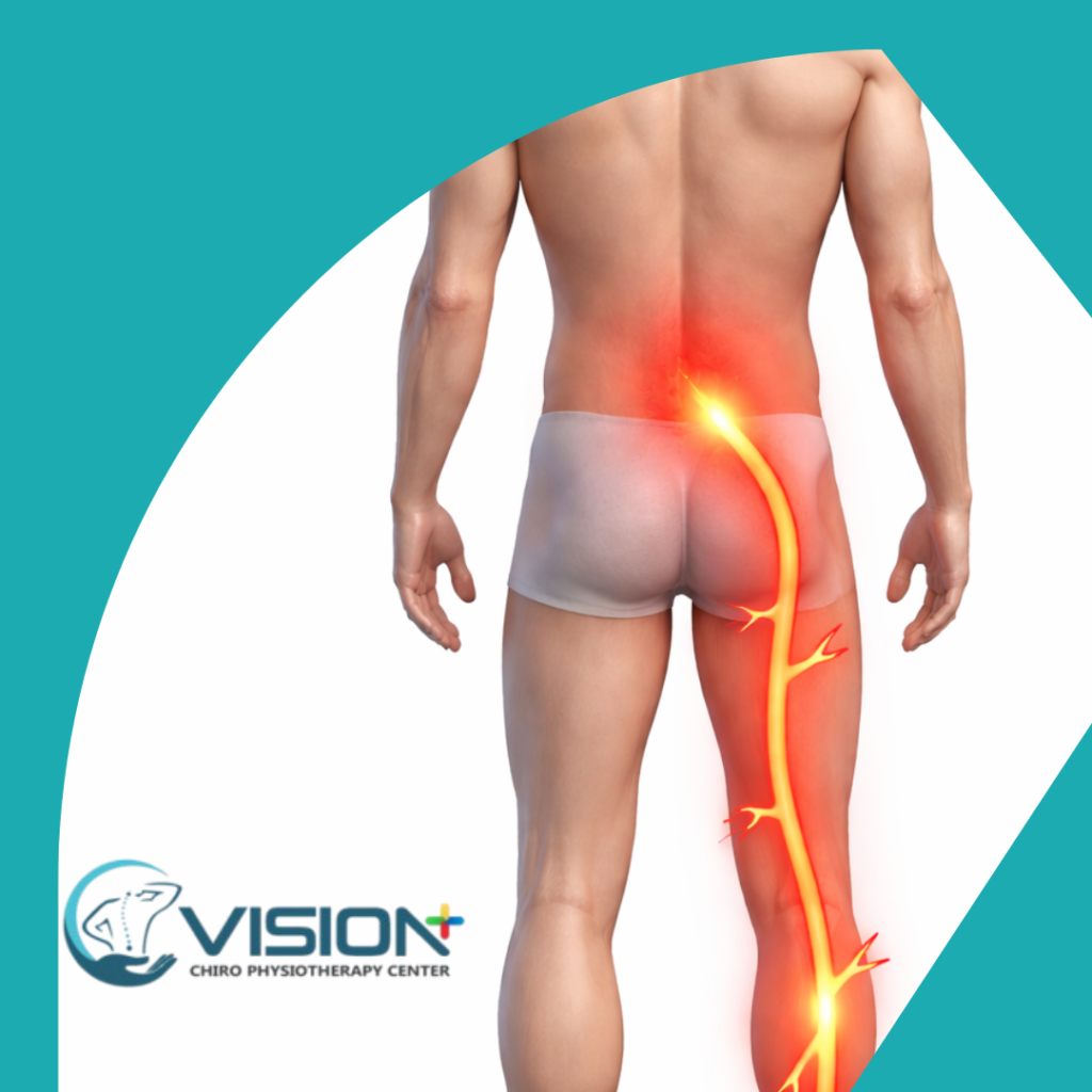 Physiotherapy for Sciatica Pain: How It Actually Works